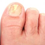 Top 5 Tips to Prevent Fungal Foot and Nail Infections