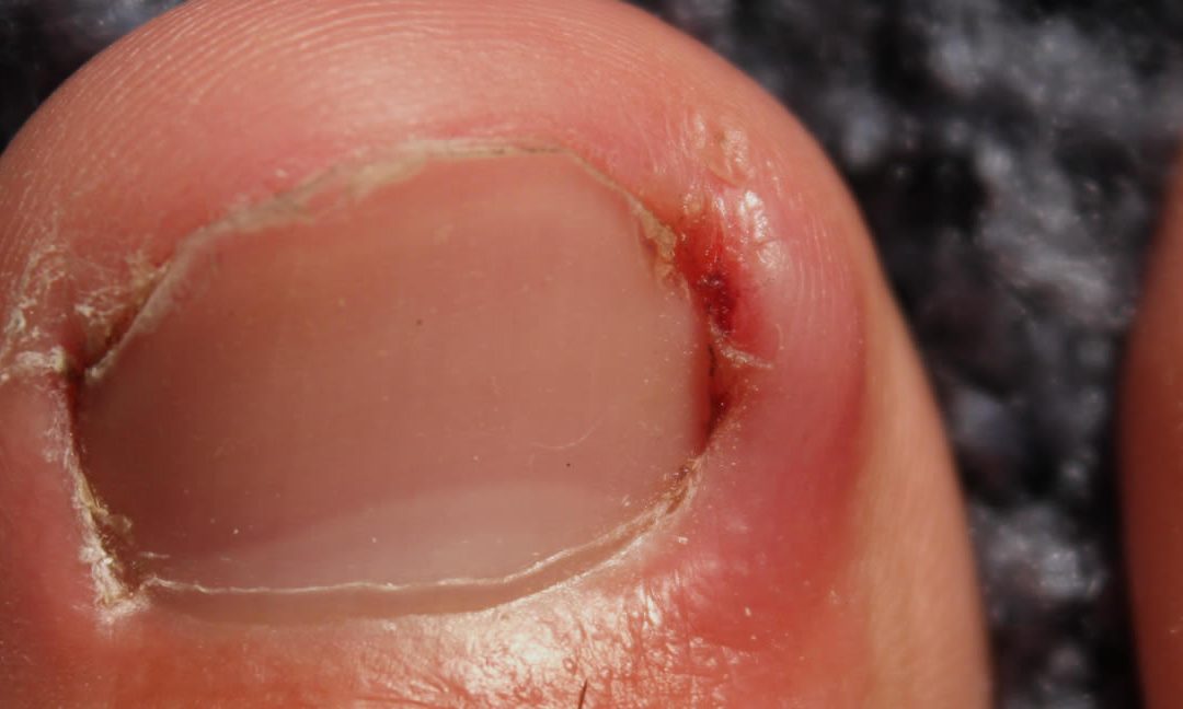 Ingrown Toenail Surgery Recovery Time Explained