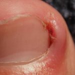 Ingrown Toenail Surgery Recovery Time Explained