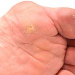 Corns and Calluses – Prevention and Treatment