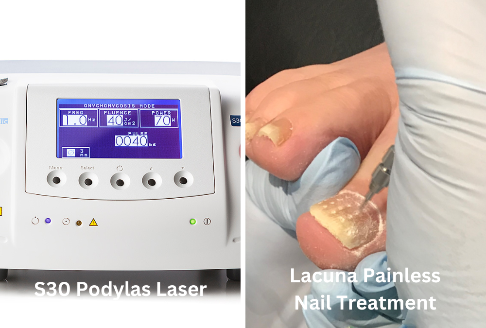 Is Laser Treatment for Fungal Toenails Right?