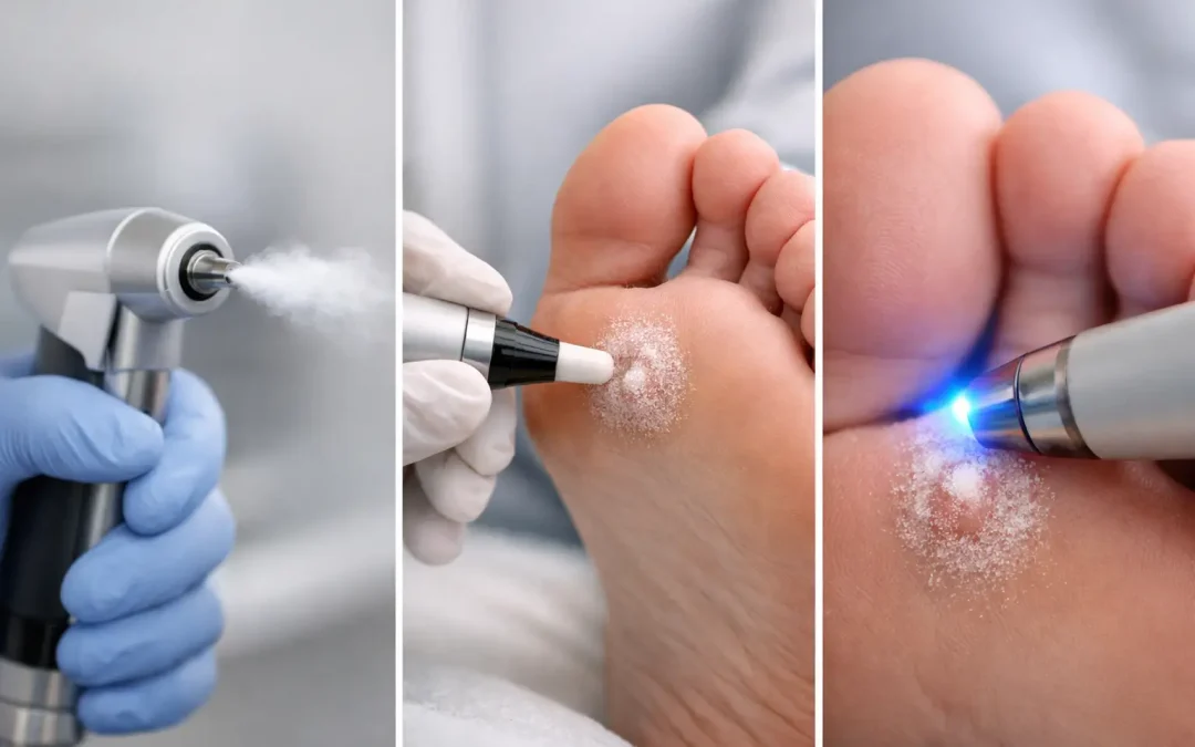 Swift Cryotherapy Comparison for Verrucae